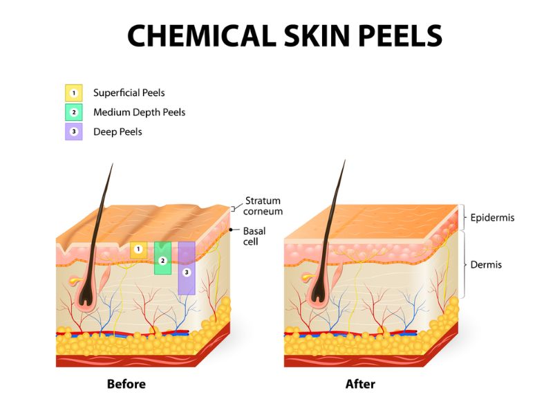 Hiểu biết cơ bản về peel da