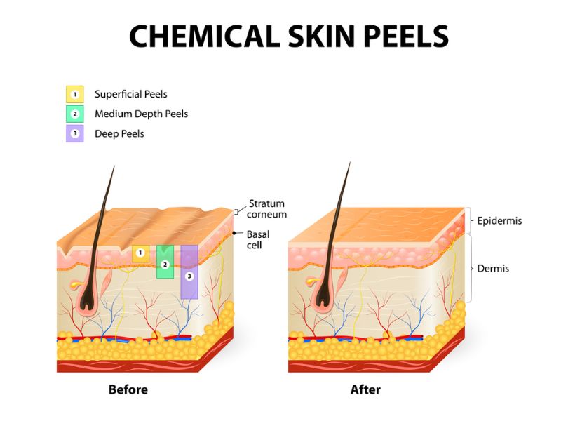 Peel da có bao nhiêu cấp độ? Có nên peel da hay không?