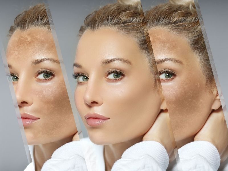 4 nguyên tắc giúp trị nám thành công