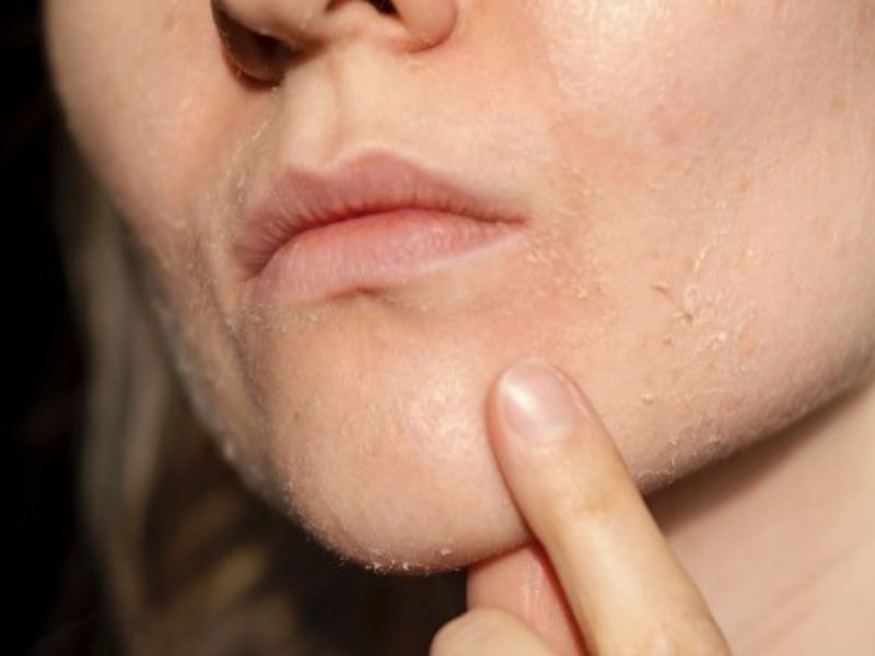Các sai lầm thường gặp trong quá trình peel