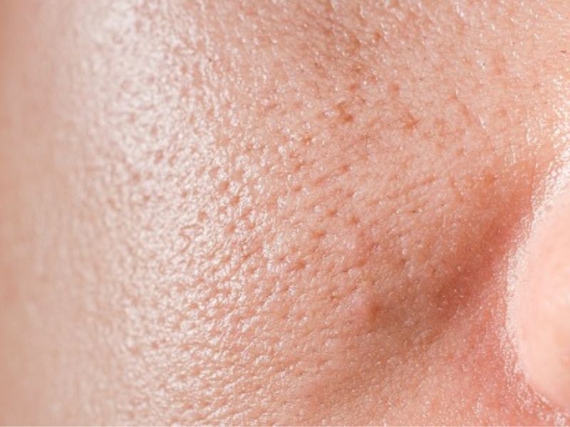 Lỗ chân lông to là dấu hiệu cho thấy bạn cần peel da