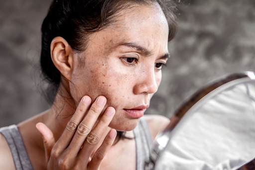 Lý do da mặt mẹ bầu dễ sạm đen