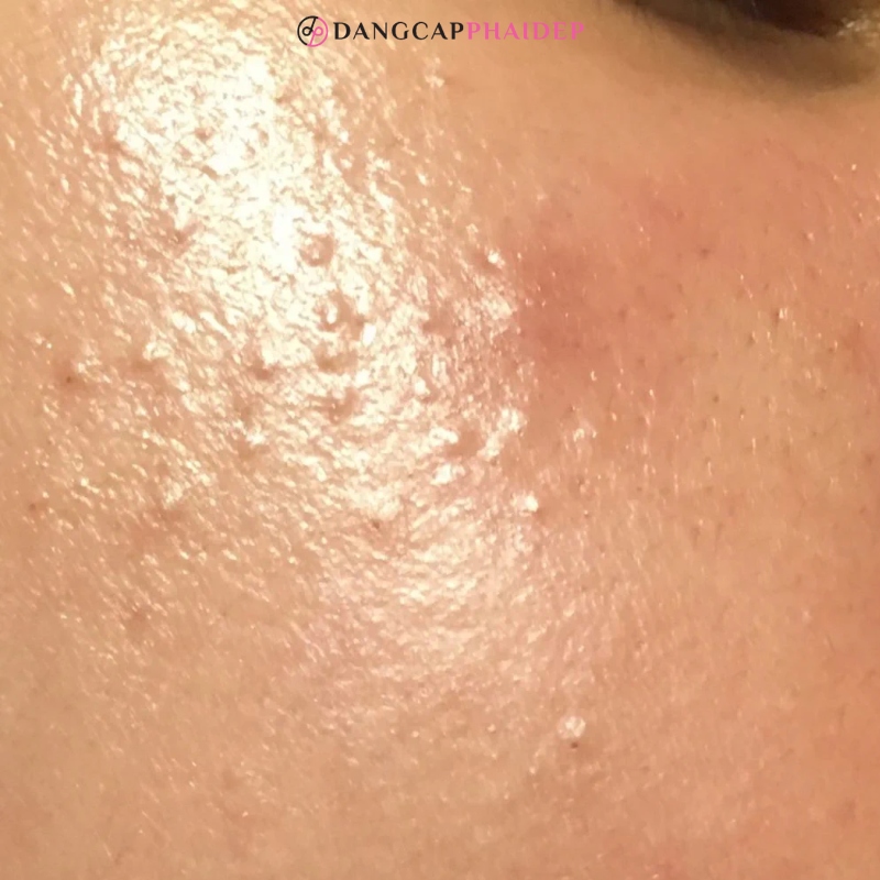 Da mụn ẩn vẫn cần thoa kem dưỡng ẩm.