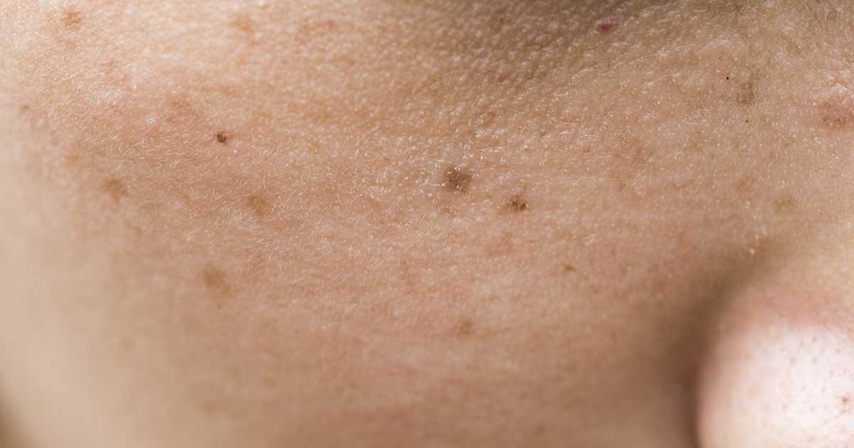 cách trị thâm mụn lâu năm