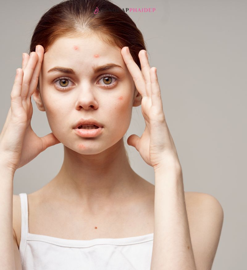 Làn da dầu mụn nên cân nhắc việc bôi kem chống nắng vào ban đêm.