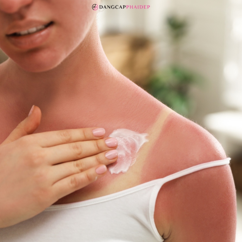 Nên sử dụng kem dưỡng phục hồi để giúp làm dịu làn da bị cháy nắng. 