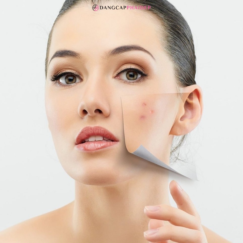 Ngay sau khi hết mụn hãy tập trung trị thâm.