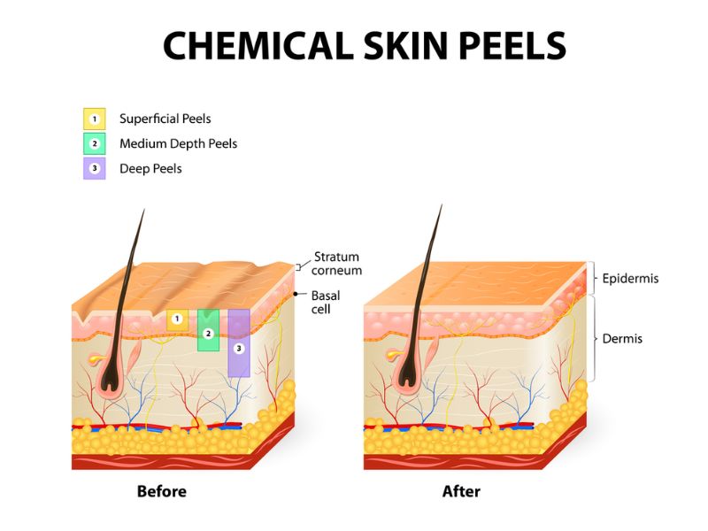  Peel da là gì? Ưu và nhược điểm của phương pháp peel da