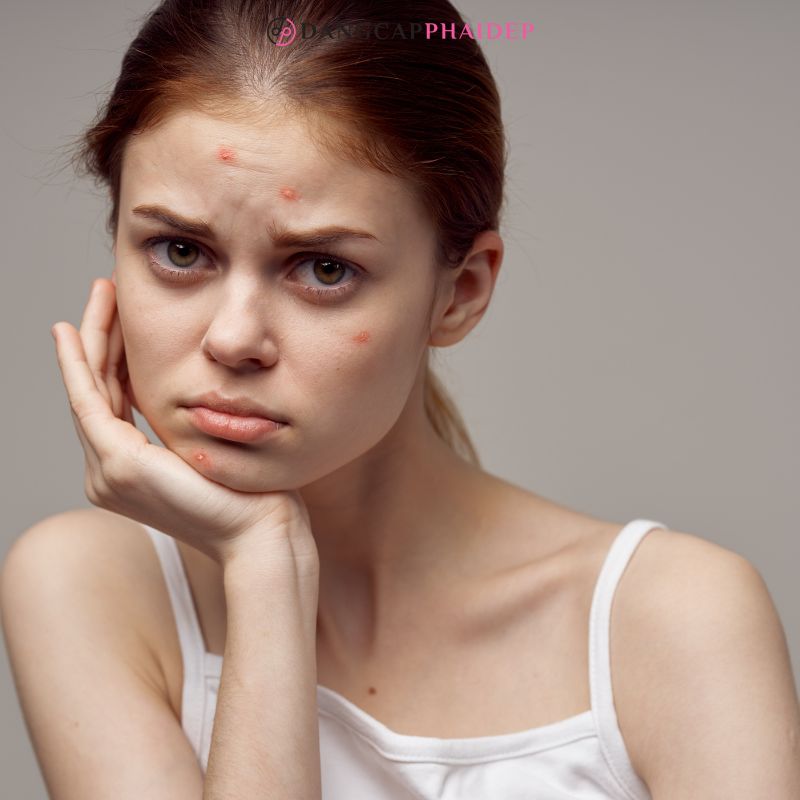 Da nổi mụn là dấu hiệu nhận thấy khi dị ứng kem chống nắng.