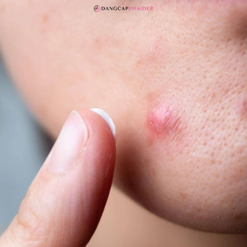 Mụn cục cứng dưới da khó có thể thể tự hết được.
