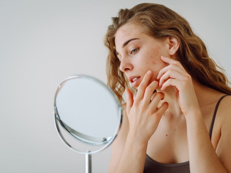 Nặn mụn làm cho tình trạng mụn tệ hơn, dễ dẫn đến viêm nhiễm
