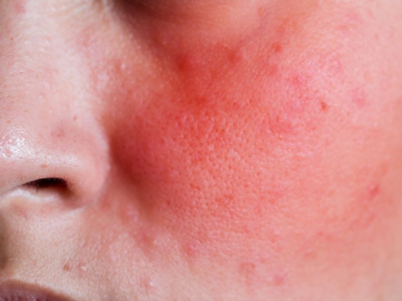 Do đỏ sau peel do nhiễm trùng