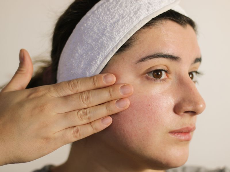 Peel da bị đỏ: Tác dụng phụ sau khi peel và cách phục hồi da