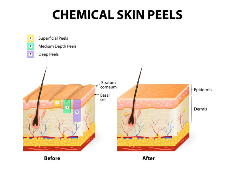 Cơ chế tác động của quá trình peel da