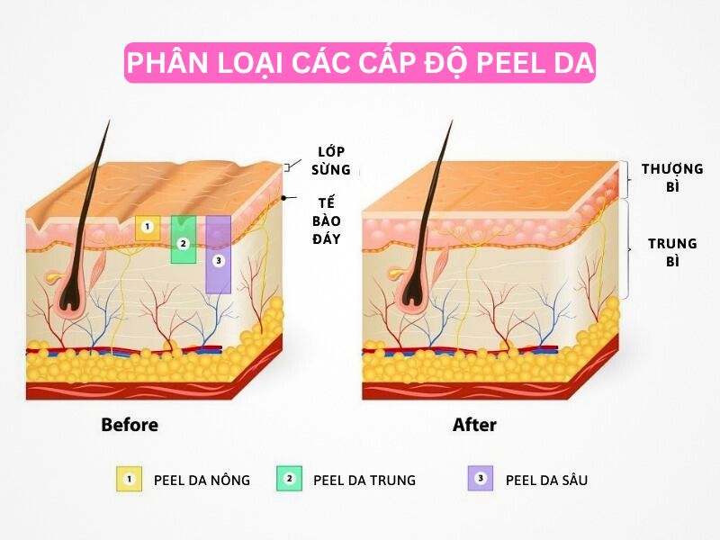Phân loại các cấp độ peel da