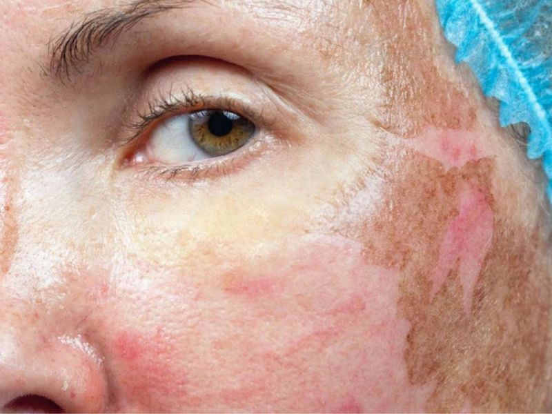 Rủi ro khi peel da sâu không đúng cách