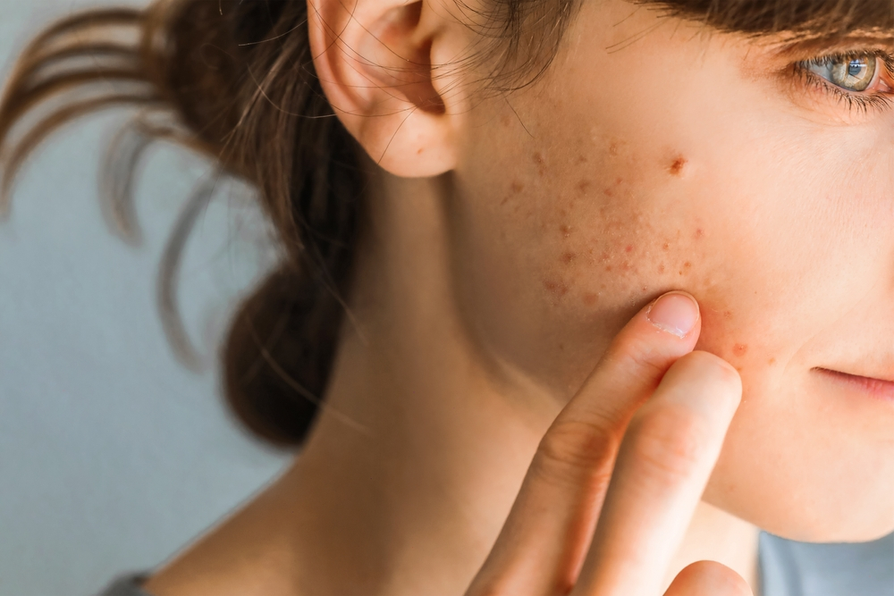 Niacinamide thích hợp với làn da dầu mụn, da có vấn đề thâm đỏ
