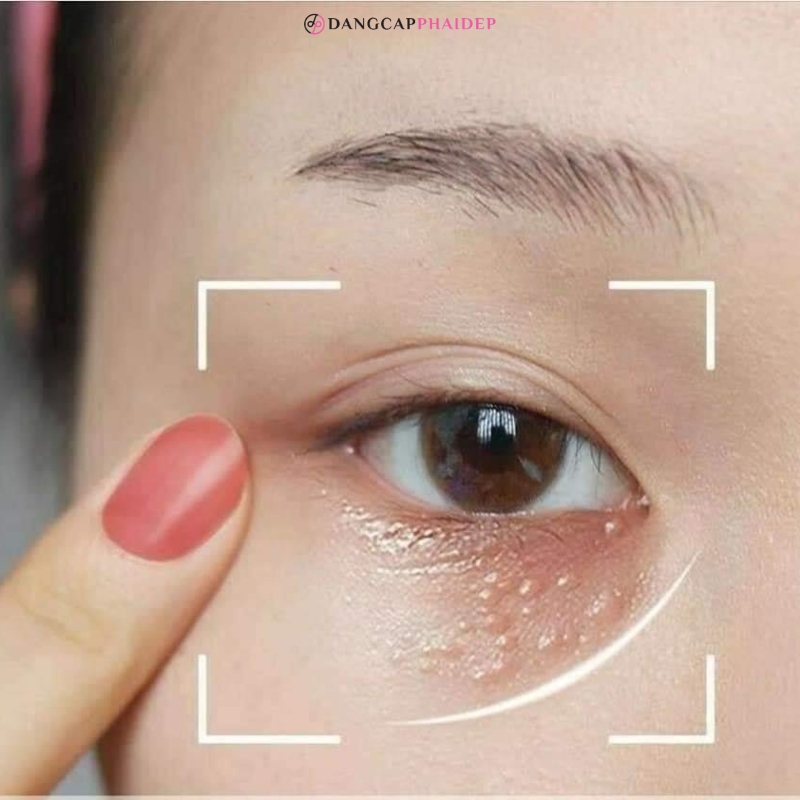 Làm thế nào để trị mụn thịt dứt điểm?
