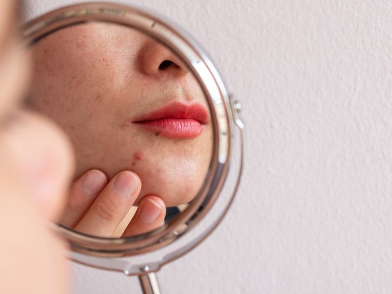 Uống collagen bị nổi mụn: Nguyên nhân và xử lý