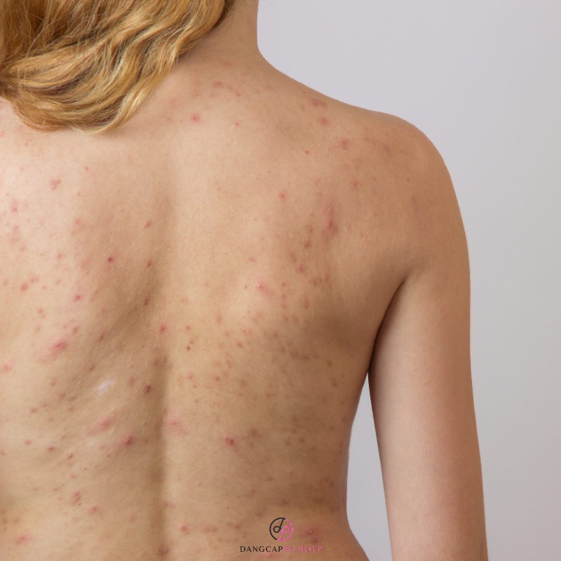 VI Peel Body cải thiện khuyết điểm trên body một cách hiệu quả.